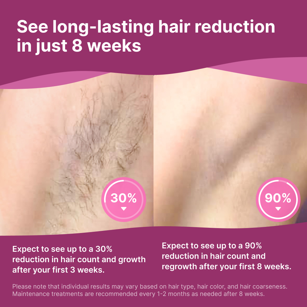 Beam At-Home IPL Hair Removal System